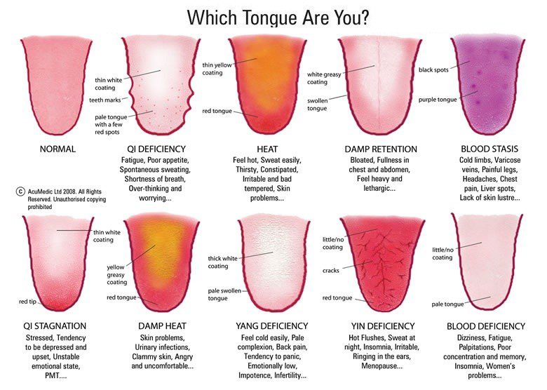 Tongue Diagnosis Chart from Acumedic: Clinic.Acumedic.com Different tongue profiles and what they mean. (chart)
